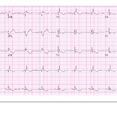 Ecg Showing Right Axis Deviation With Right Atrial And Ventricular