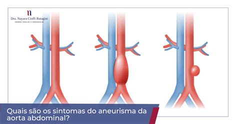 Infrarenal diameter >3cm or >50% increase in size of diameter. Quais os Sintomas da Aneurisma da Aorta Abdominal?