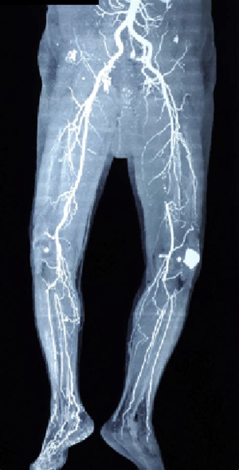 Lower Extremity Angiography