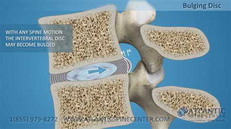 What Is A Bulging Disc Atlantic Spine Center