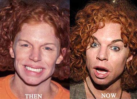 Carrot Top Plastic Surgery Before And After Photos