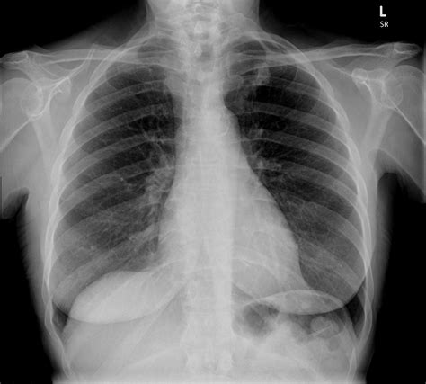 T1b Apical Lung Cancer Radiology Case