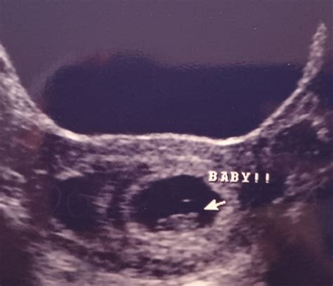 What Did Your 8 Week Ultrasound Look Like Babycenter
