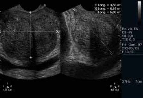 Initial Transrectal Prostate Ultrasound Where Longitudinal Transverse