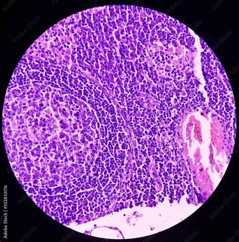 High Grade Mucoepidermoid Carcinoma Of Parotid Cyst Microscopic Show