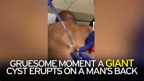 Mans Huge Cyst Is Popped In Stomach Churning Video Cysts Blackheads Popping Stomach