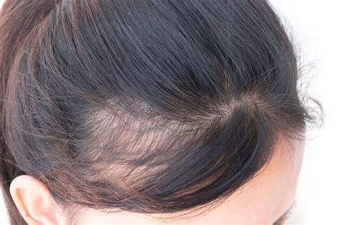 I have read a number of blogs including this one that indicate that hair loss is a side effect yet the wellbutrin trials only listed hair loss as a side effect for less than 1% of patients. PCOS Related Hairfall Gets More Effective Treatment ...