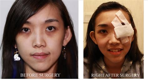 Dark Eye Circle Eye Bag Removal Surgery In Singapore Blepharoplasty