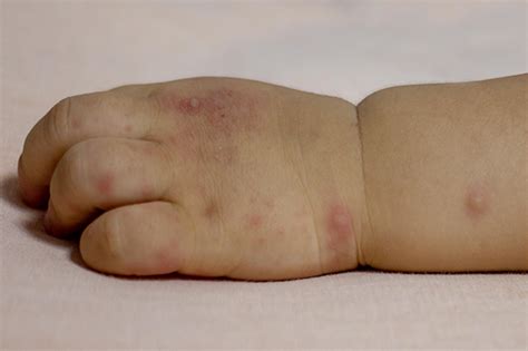 Hand Foot And Mouth Disease The Childrens Medic