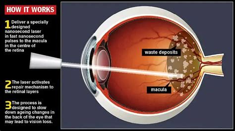 Macular Degeneration Treatment