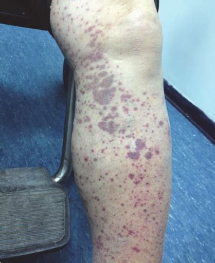 Palpable Petechiae And Purpura In The Left Leg Particularly Around The