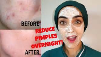 how to remove pimples overnight reduce pimple size redness instantly ~ immy youtube
