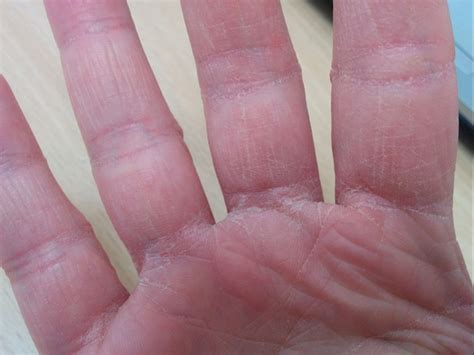 Very Dry Skin On Hands Is This What Scleroderma And Ray