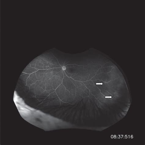 Granulomatosis With Polyangiitis Ento Key