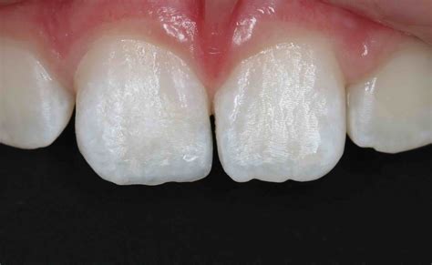 White Fillings Frequently Asked Questions Composite Fillings Before After