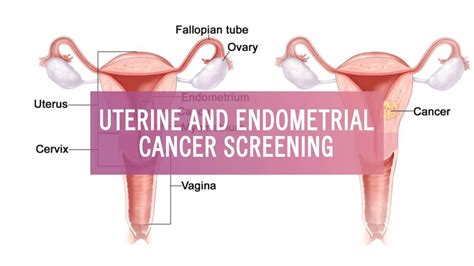Inform your doctor of any irregular vaginal bleeding, particularly bleeding more than once a month or heavy bleeding, at any age. Narikaa: Uterine And Endometrial Cancer Screening