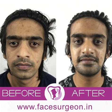 Aggregate More Than 141 Hair Transplant In Patna Latest Tnbvietnam Edu Vn