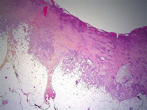 Cureus Two Cases Of Oligometastatic Basal Cell Carcinoma A