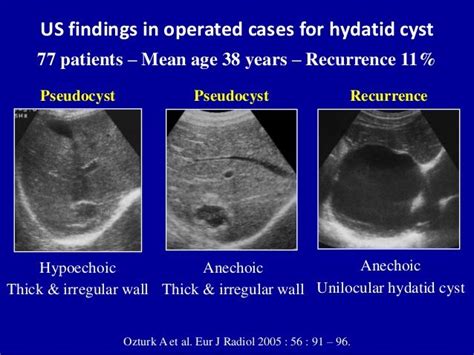 Cystic Liver Lesions An Ultrasound Perspective Ultrasound