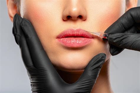 Bótox en los labios Puede aplicarse este tratamiento