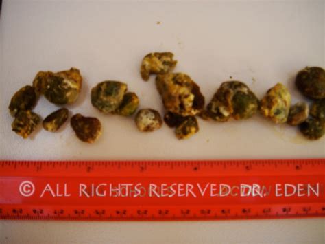Gallstone Pictures Gallery See Images Of Real Gallstones Passed