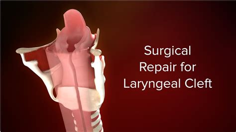 Medical Animation Surgical Repair For Laryngeal Cleft Cincinnati