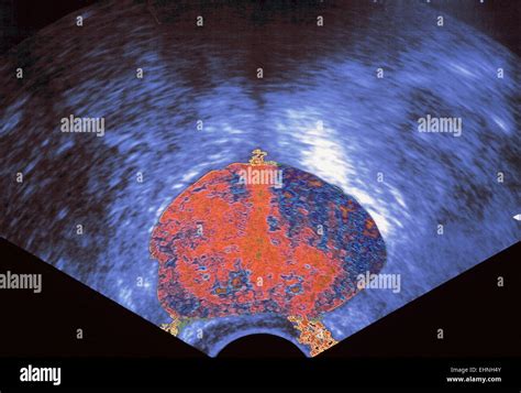Ultrasound Scan Of The Prostate Stock Photo Alamy