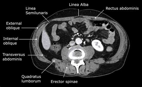 The Radiology Assistant Abdominal Wall Hernias