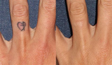 Picosure Tattoo Removal San Diego Ca Cosmetic Laser Dermatology