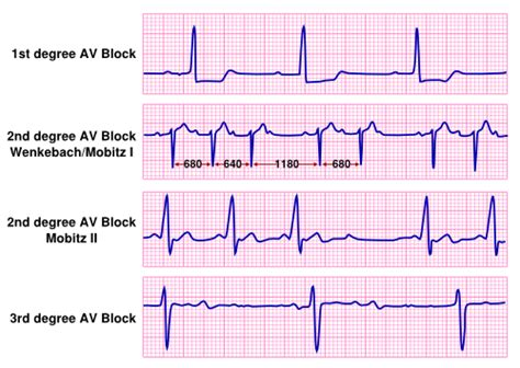 In this type of block, electrical signals don't pass from your atria to your heart block may cause no symptoms. Bradycardia - Textbook of Cardiology