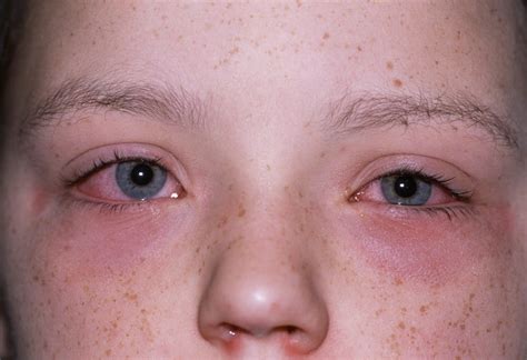 Allergic Conjunctivitis Eye Disorders Msd Manual Professional Edition