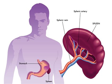 Splenomegaly Ayurveda Concept Symptoms Causes Remedies