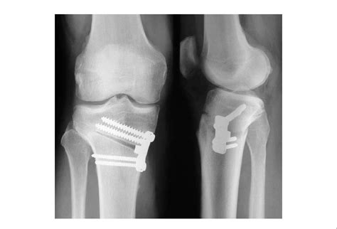 Anteroposterior And Lateral Radiographs After Open Wedge High Tibial