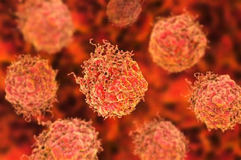 Tumor Cell Type Identified That Makes Prostate Cancer More Aggressive