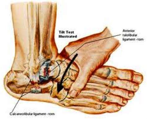 Ankle Ligament Tear Fit 4 Physio