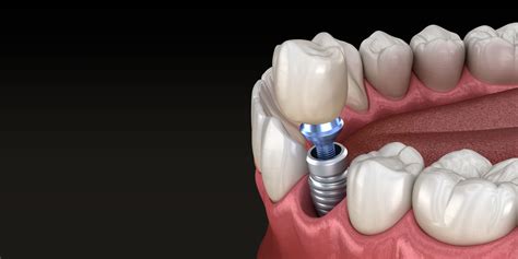 Single Dental Implants Grace Dental Framingham Ma