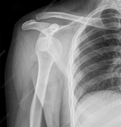 Dislocated Right Shoulder X Ray Stock Image F0356561 Science