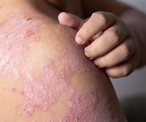 Sintético 92 Imagen Fotos De Dermatitis En Las Manos Alta Definición