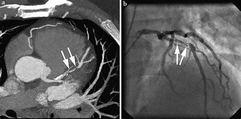Cardiac Imaging In The Patient With Chest Pain Coronary Ct Angiography