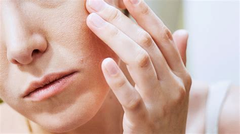 Eczema On The Face How To Treat It According To Dermatologists Allure