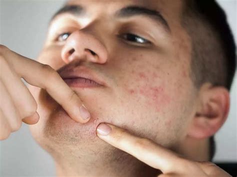 Nodular Acne Symptoms Causes And How To Treat It Ph