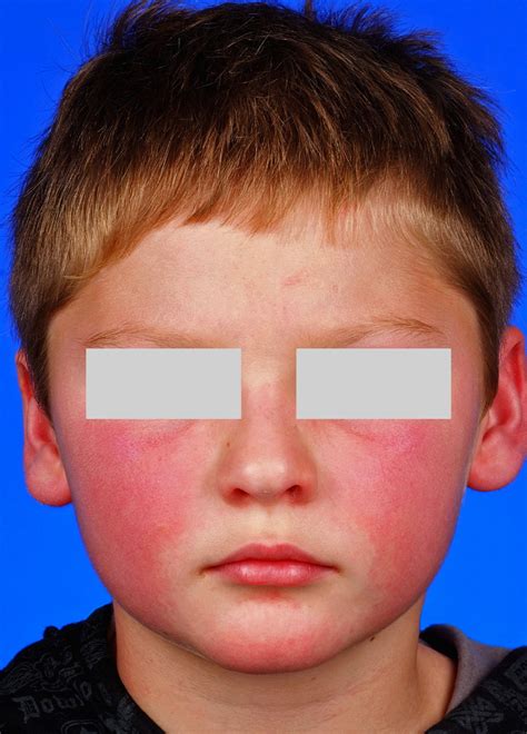 Juvenile Dermatomyositis In An 8 Year Old Boy