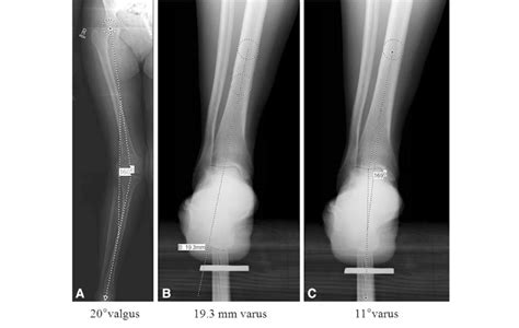 A C A Mechanical Axis Alignment Shows Valgus Knee Deformity B