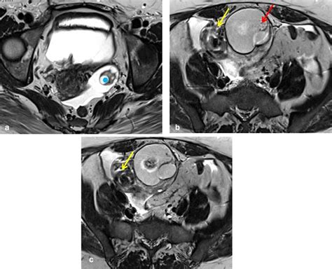 A B C Axial T2 Mri Figure A Shows The Normal Left Ovary Blue
