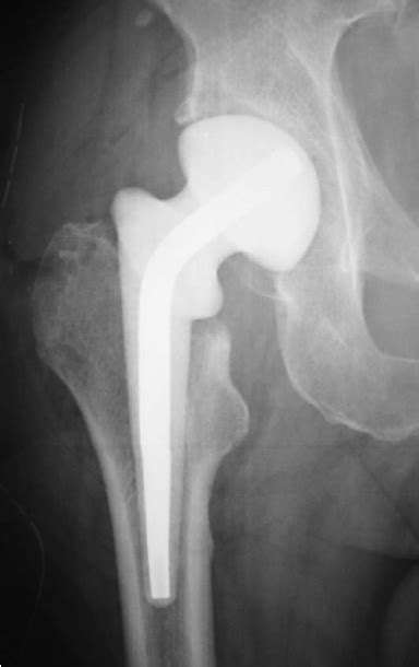 X Ray Taken Two Years Following The Uncemented Total Hip Replacement