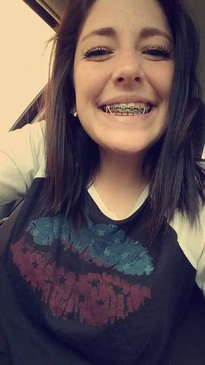 Girls With Braces On Tumblr Hot Sex Picture