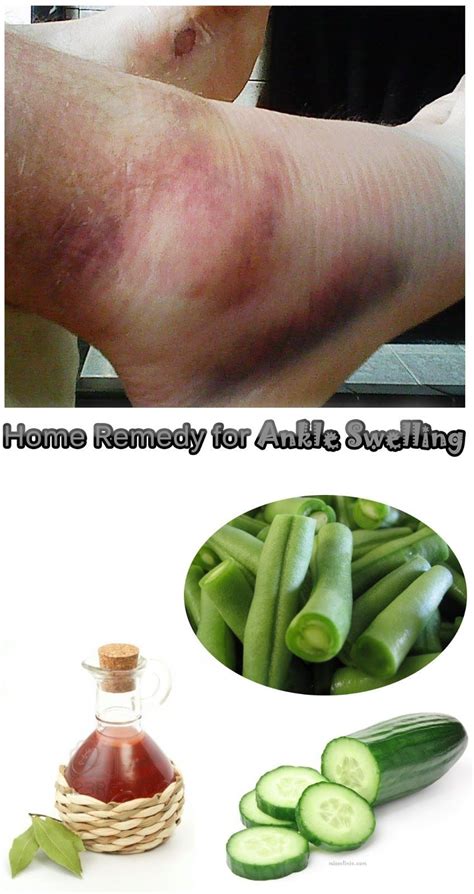 Home Remedies For Ankle Swelling Charity Host Littler Home Health Remedies Natural Home