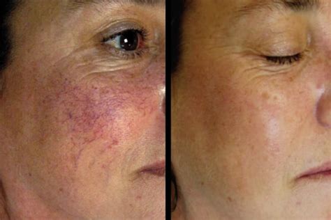 How To Treat Cracked Capillaries And Redness On The Face