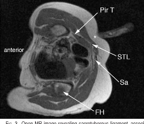 Figure 3 From Diagnosis And Treatment Of Pudendal Nerve Entrapment