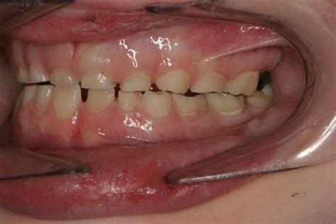 Often sleep bruxism may only be a mild problem, requiring little if any treatment. Grinding teeth in sleep child